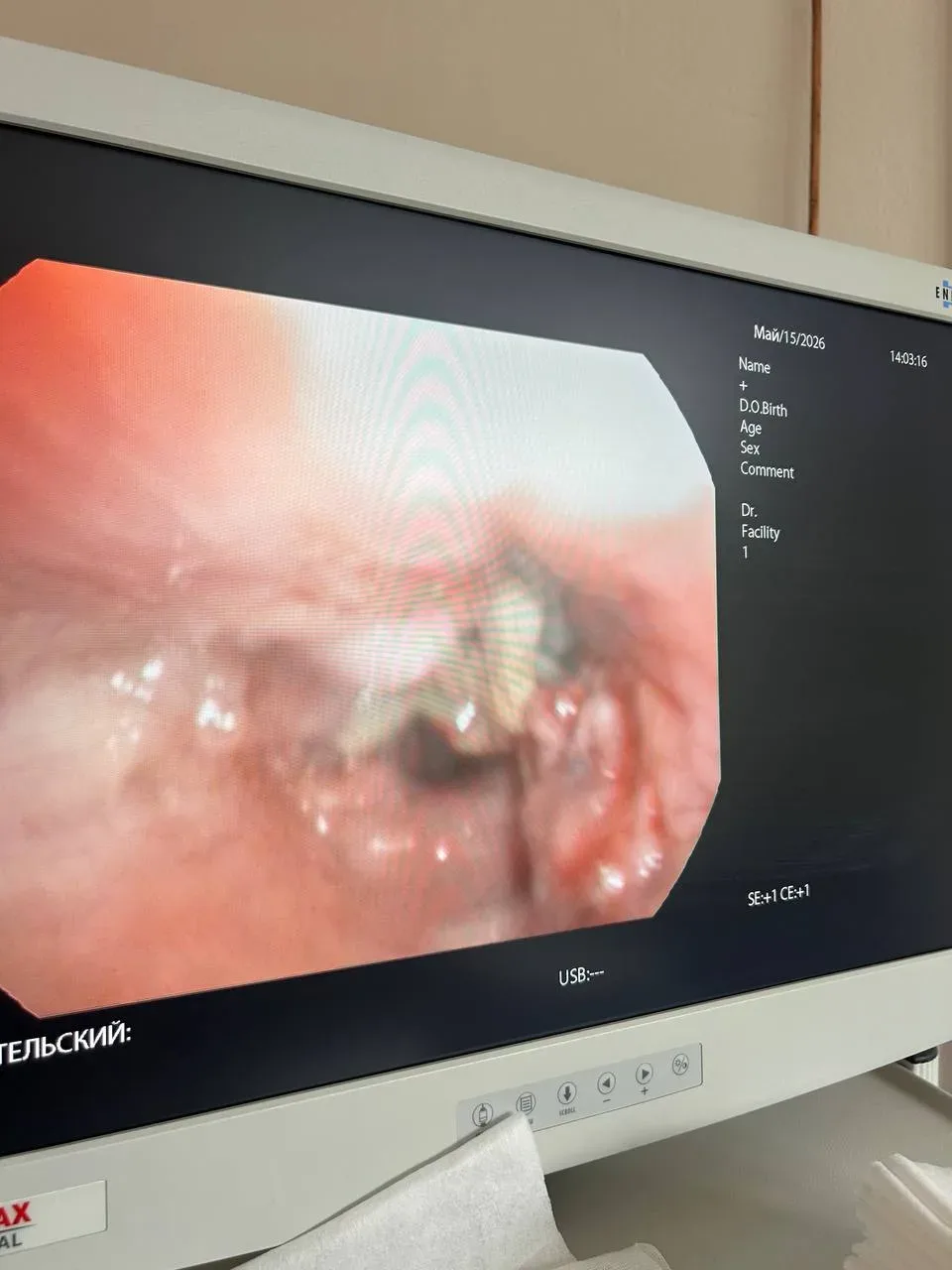 👩‍⚕️👨‍⚕️Врачи-эндоскописты Городской клинической больницы №1 успешно извлекли «давнее» инородное т