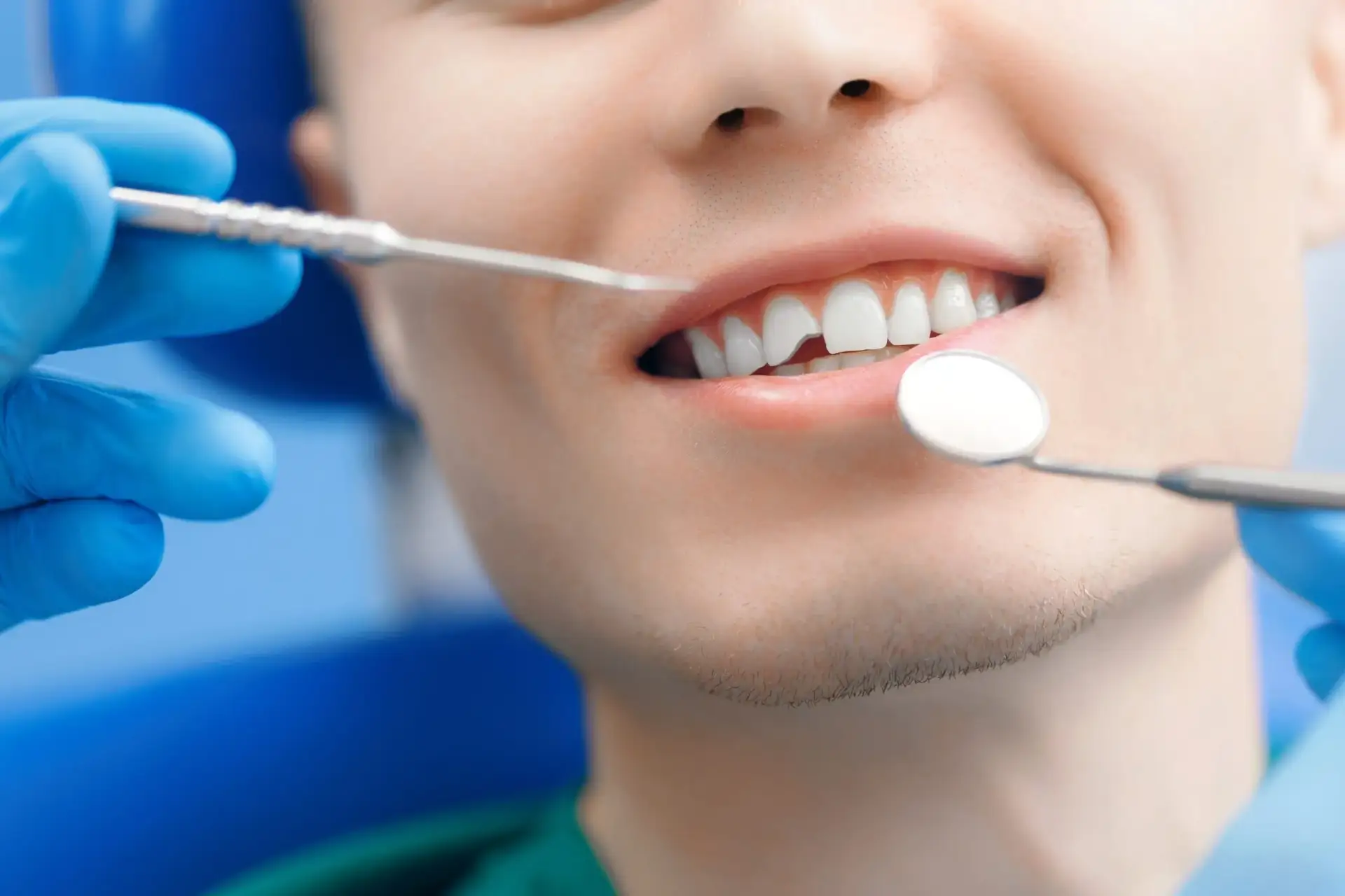 🦷  Передний зуб скололся, потемнел или выглядит неровно?

Многие думают, что восстановить красивую 