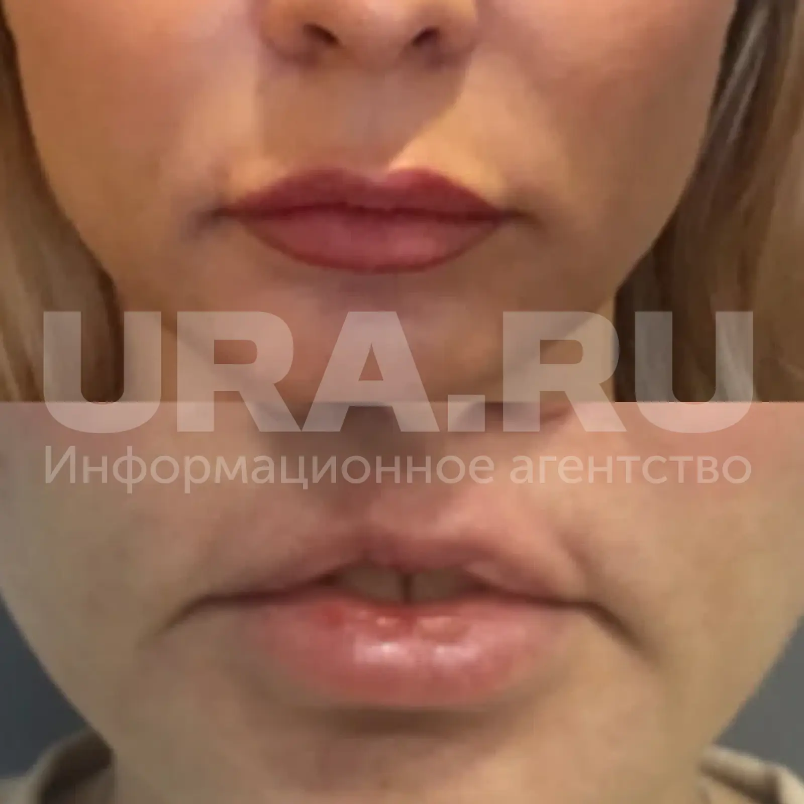 Губы не смыкались, еда вываливалась: чем закончился поход екатеринбурженки к пластическому хирургу  