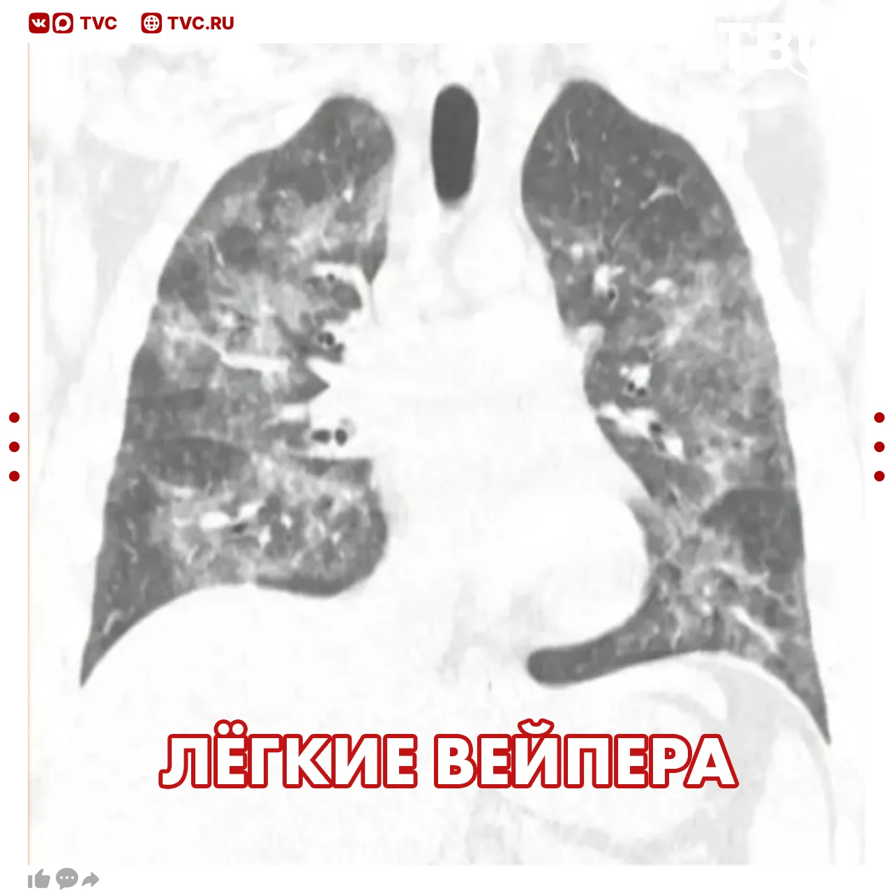 Легкие частично отказали у 19-летнего парня из Саратовской области из-за вейпа  Парень пять лет кури