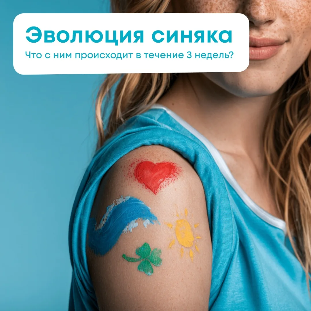Фиолетовый, зелёный, жёлтый — как эволюционирует синяк?