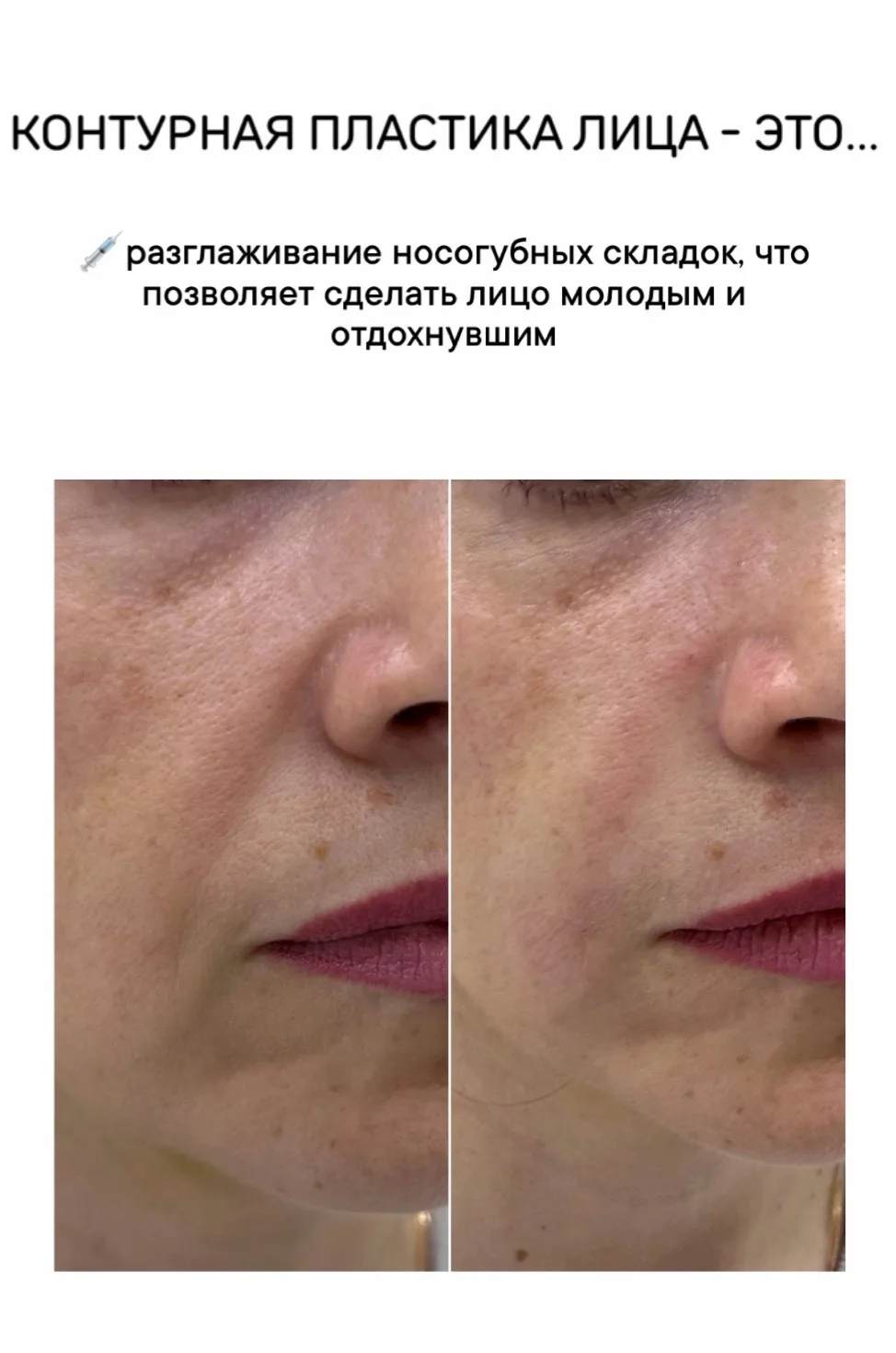 Только 5 мест на контурную пластику лица - УЖЕ ЗАВТРА