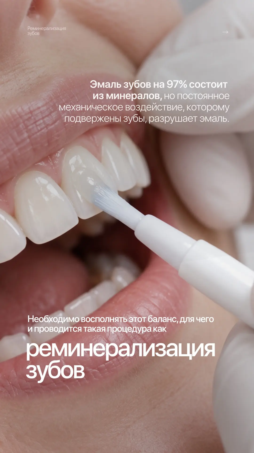 📌 РЕМИНЕРАЛИЗАЦИЯ ЗУБОВ