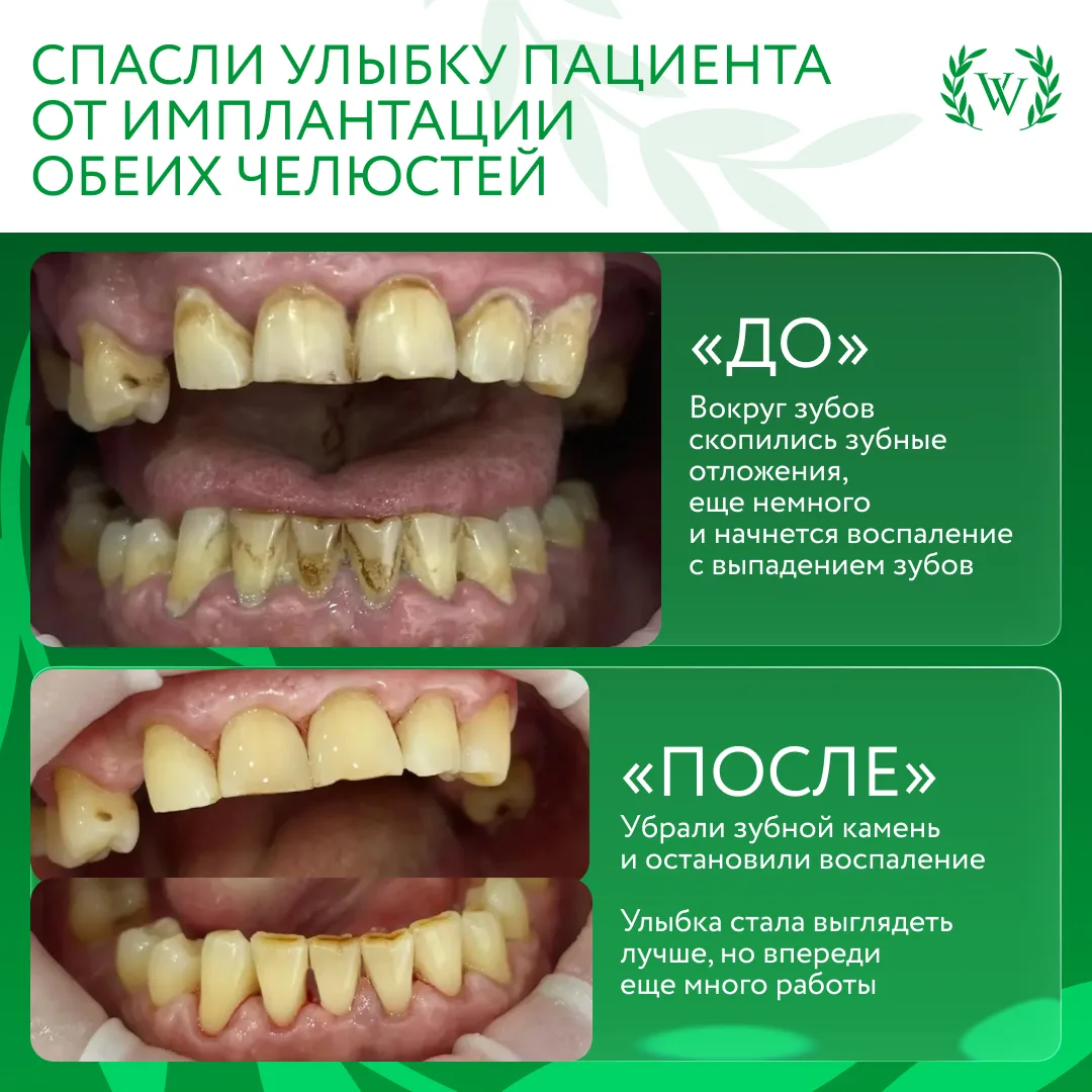 Профессиональная чистка спасла пациента от имплантации обеих челюстей😱