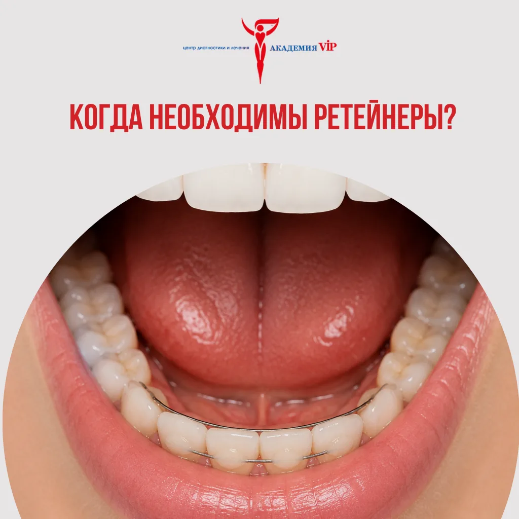 После ношения брекетов зубы могут снова «уехать» назад.
