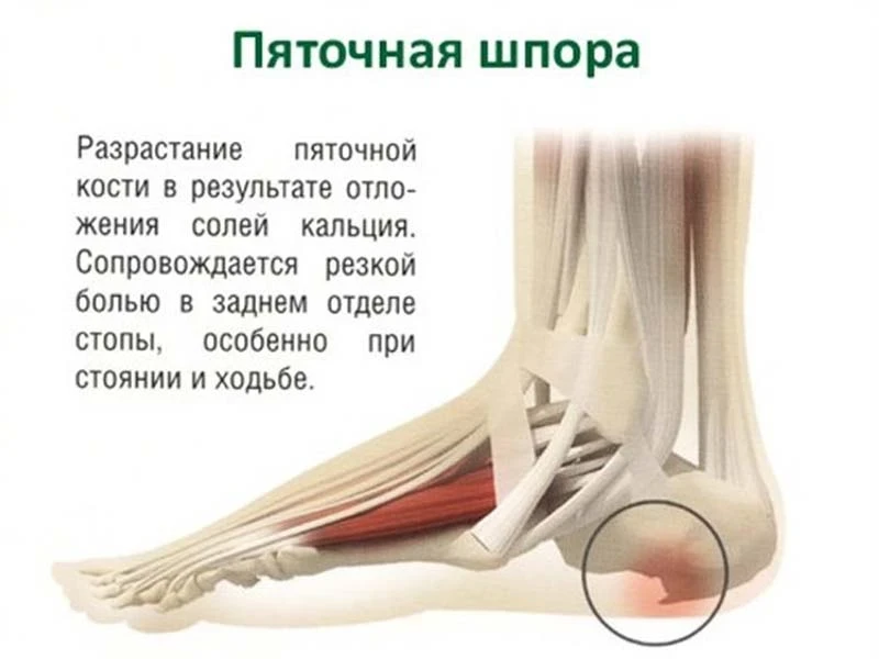 Пяточная шпора.
