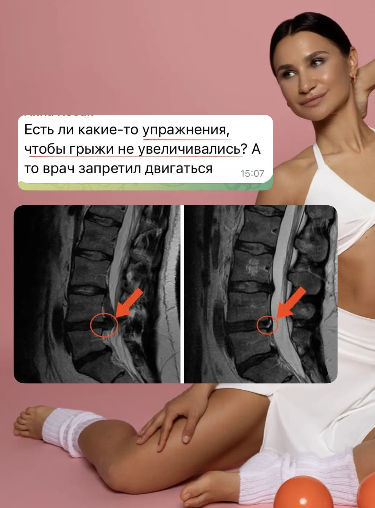 «Грыжа может становиться только больше…»