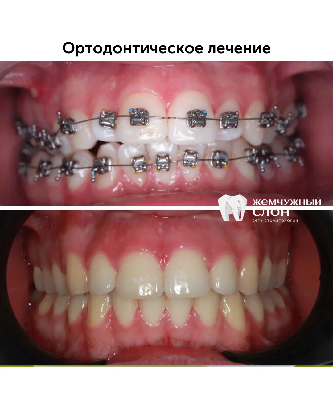 Безлигатурные брекеты - фавориты у пациентов, ведь с ними не нужно ходить раз в месяц н...