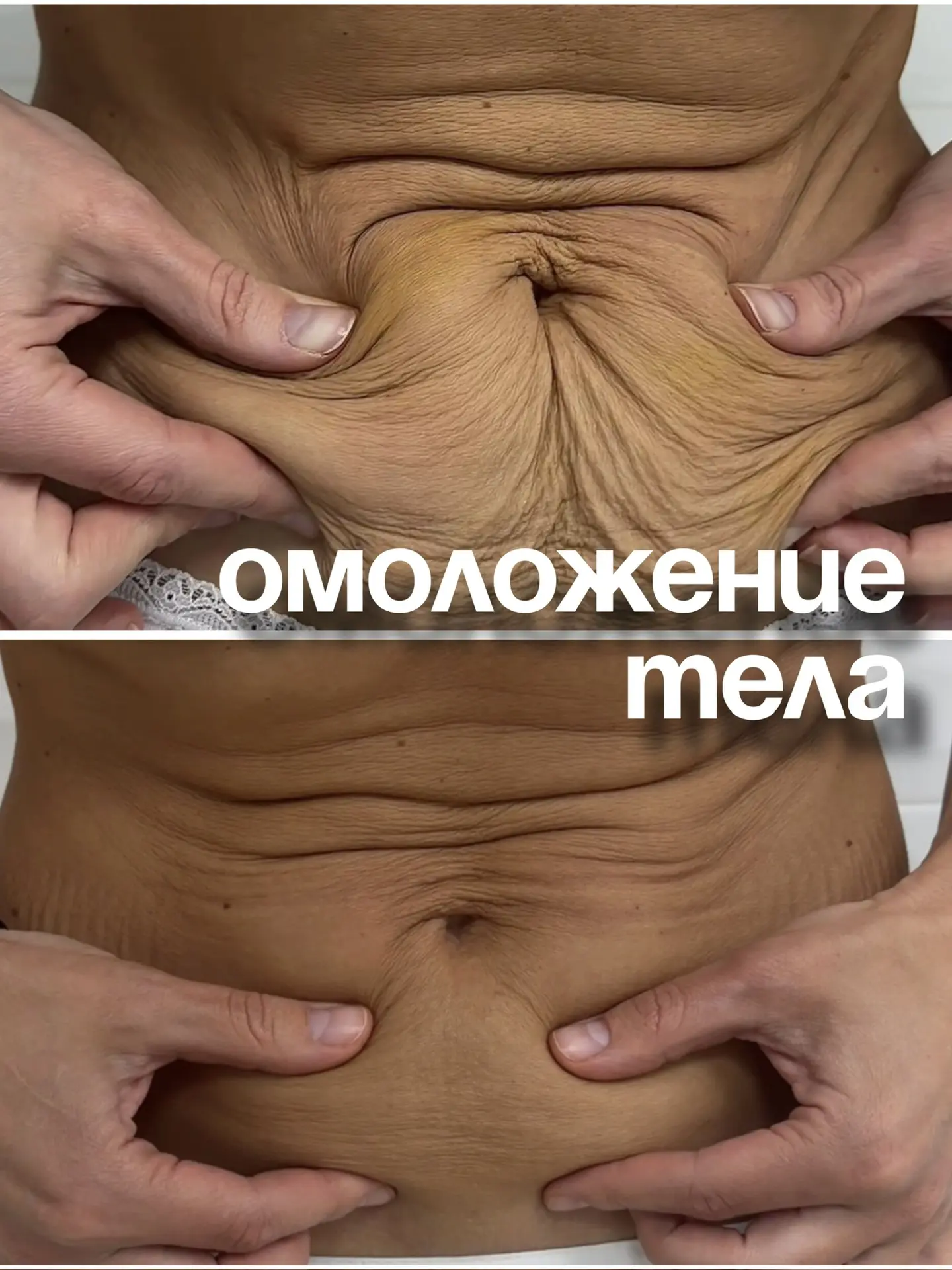 Подтяжка тела без операции 🔥