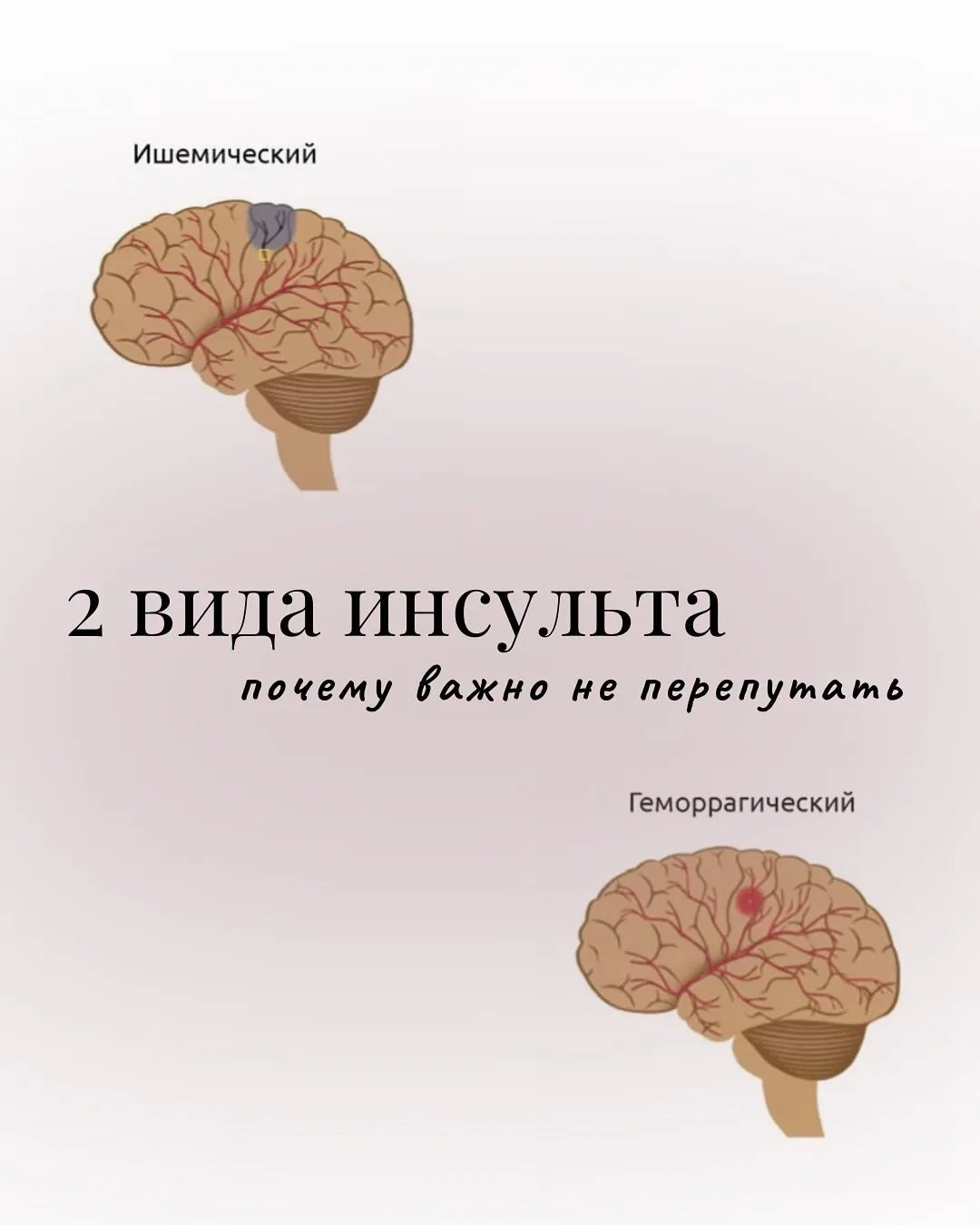 Инсульт бывает разным - и от этого зависит жизнь❗️

Многие думают, что инсульт всегда один и лечится