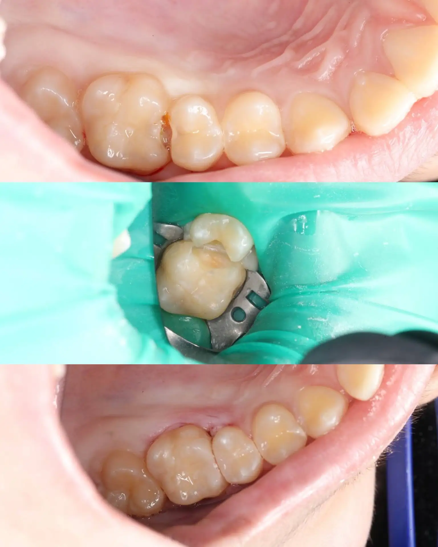 Кариес между зубами. 🦷