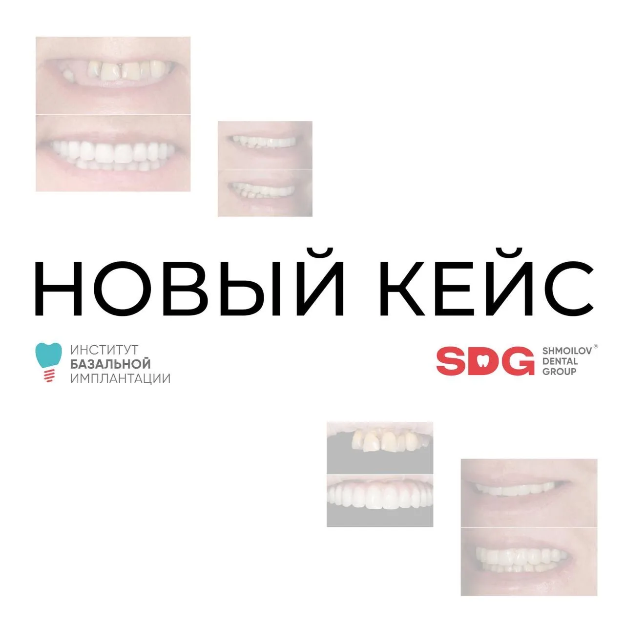 Тотальное восстановление зубов для нашего пациента — до/после