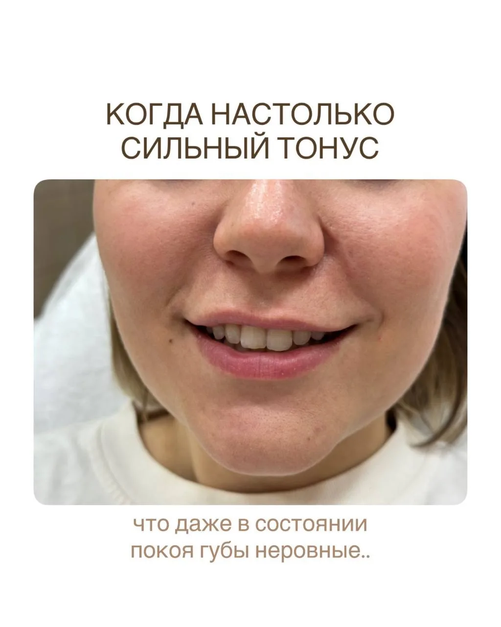 МЫШЕЧНАЯ АСИММЕТРИЯ