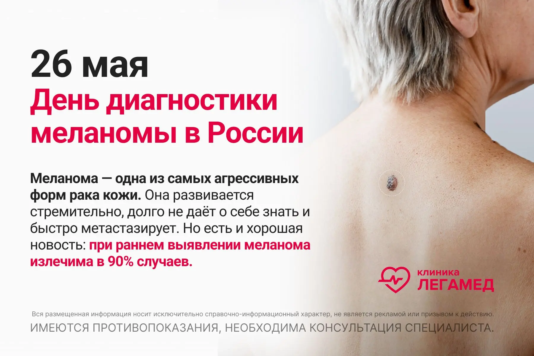 26 мая — День диагностики меланомы в России