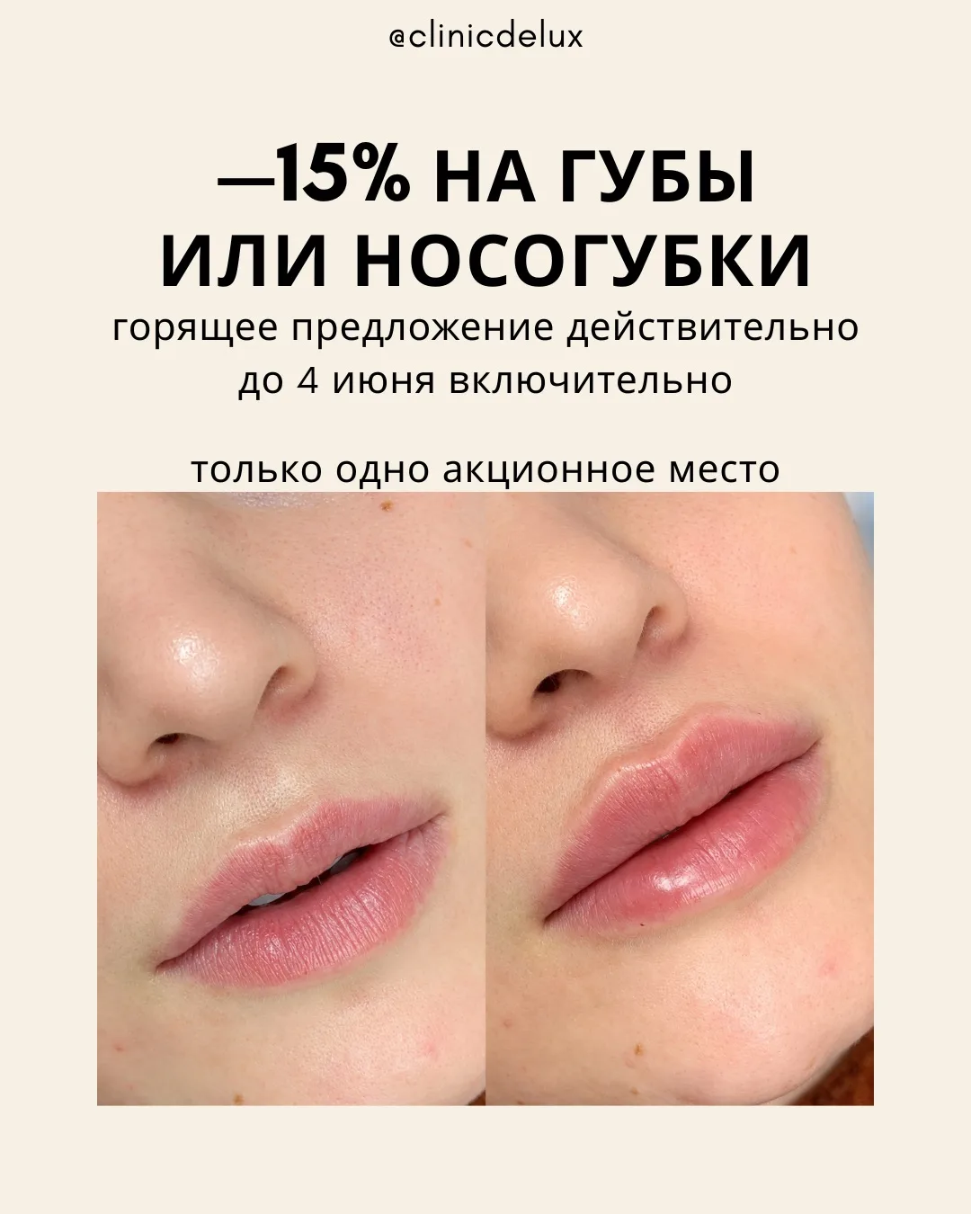 Появилось одно место на коррекцию филлером Stylage M со скидкой 15%🫦
