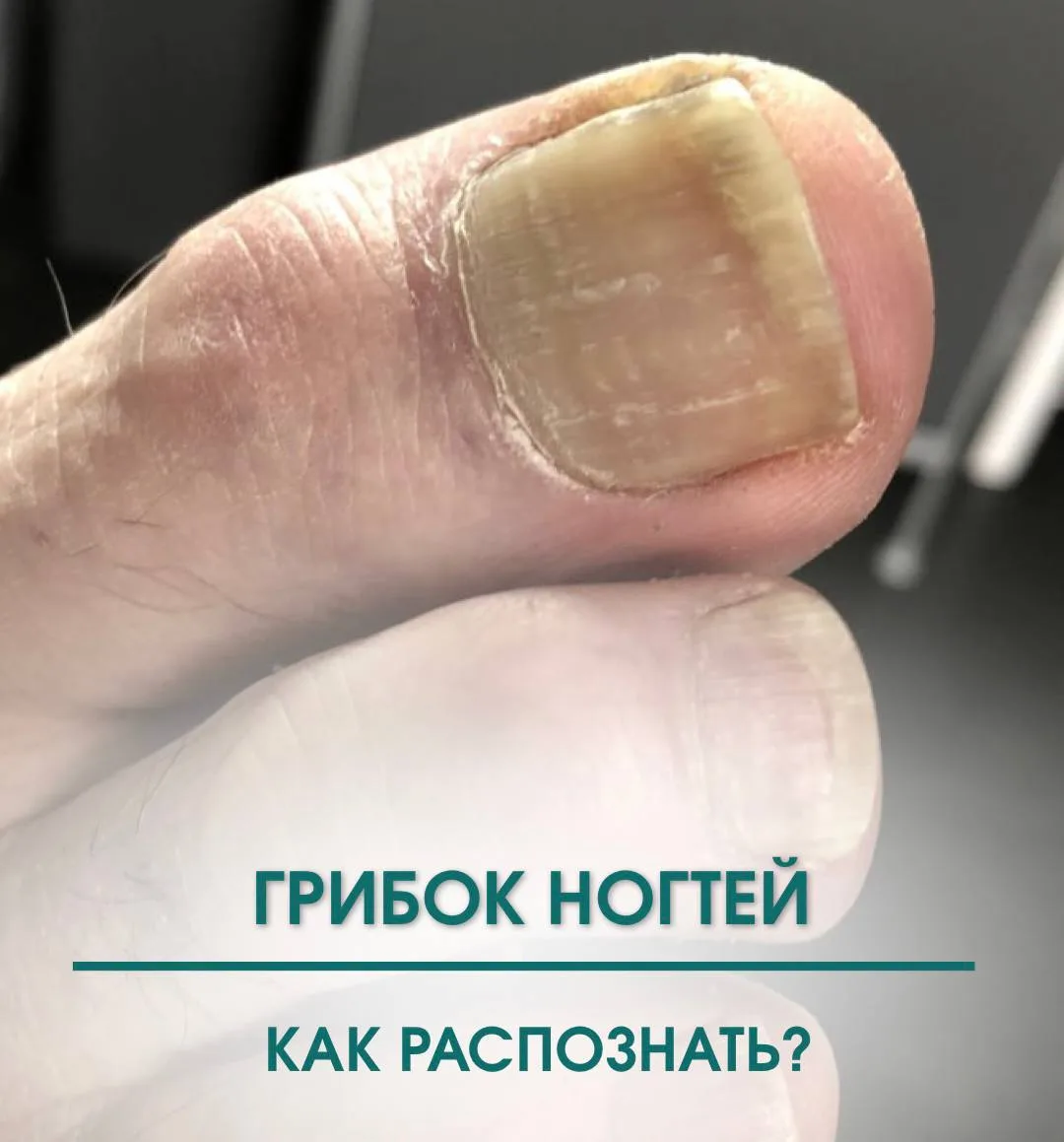 Как распознать грибок?🍄