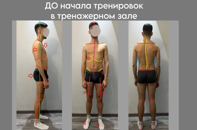 🔖ТРАВМА после занятия в ТРЕНАЖЁРНОМ ЗАЛЕ С ПЕРСОНАЛЬНЫМ ТРЕНЕРОМ в 26 лет 

Часть 2

Какие изменени