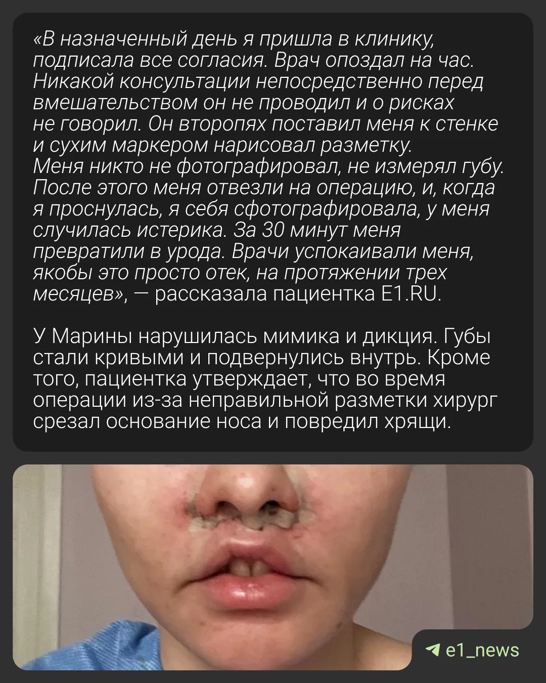 «Превратили в урода за 30 минут»  Екатеринбурженка обвинила известного хирурга в изуродованном лице.