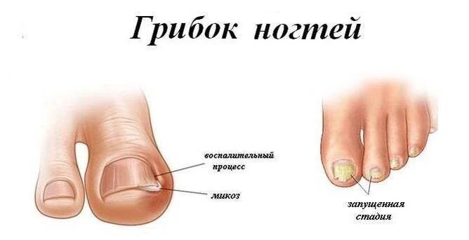 Эффективные способы справиться с грибком ✅