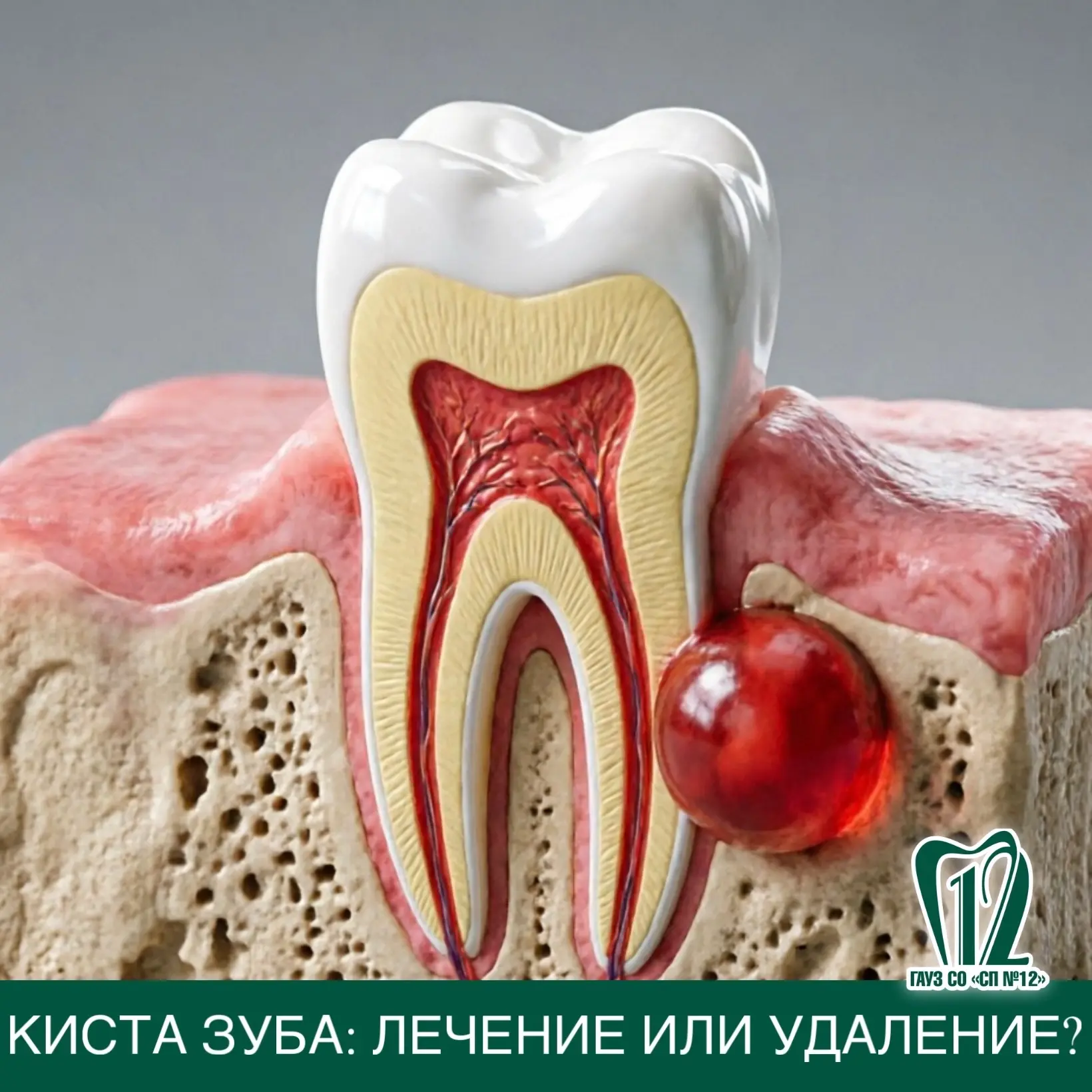 Киста зуба: лечение или удаление?