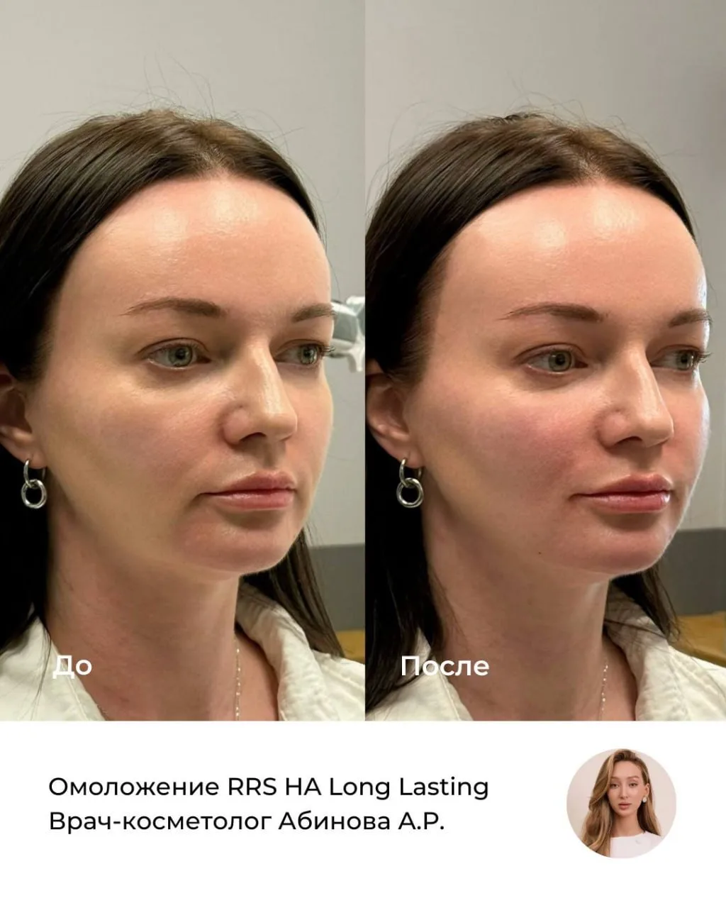Результат омоложения лица препаратом RRS HA Long Lasting от врача-косметолога Азизы Раш...
