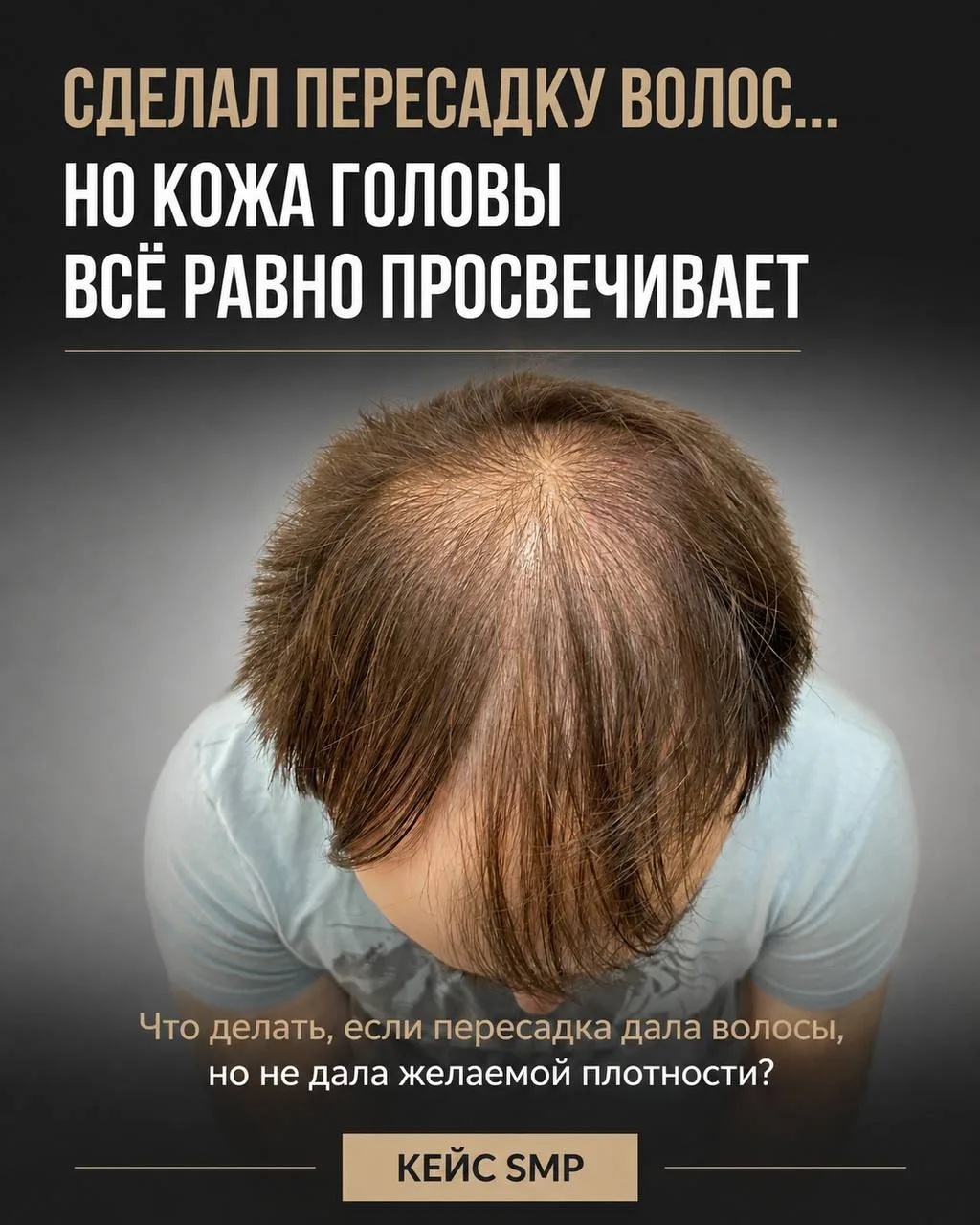 Сделал пересадку волос… но всё равно видна кожа головы?