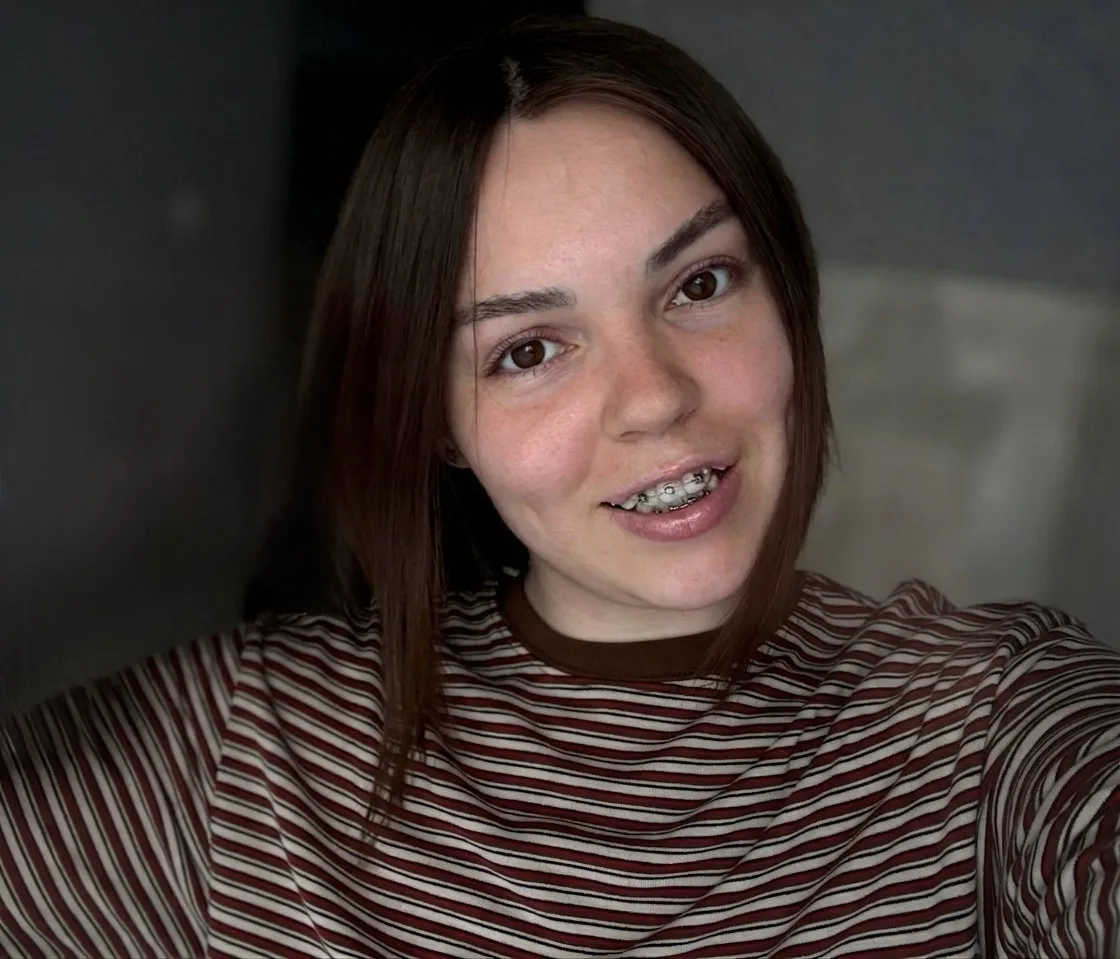 А вот и установка, сегодня четвертый день и я уже почти привыкла к брекетам. Есть тольк...