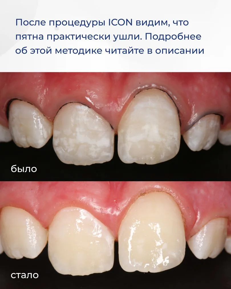 Недостаточно тщательная домашняя гигиена может привести к множественному поражению зубов. Именно это