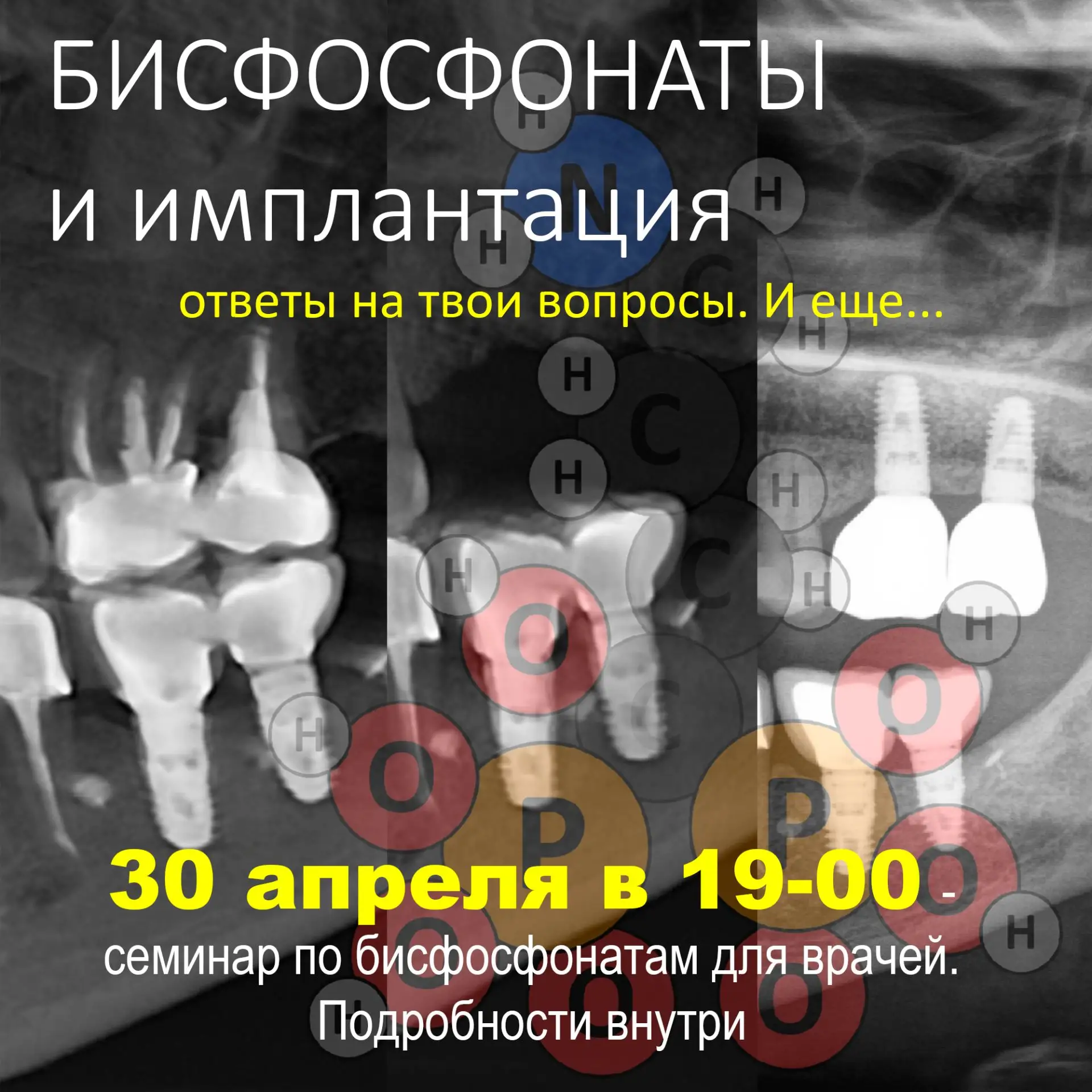 БИСФОСФОНАТЫ и ИМПЛАНТАЦИЯ: ответы на твои вопросы