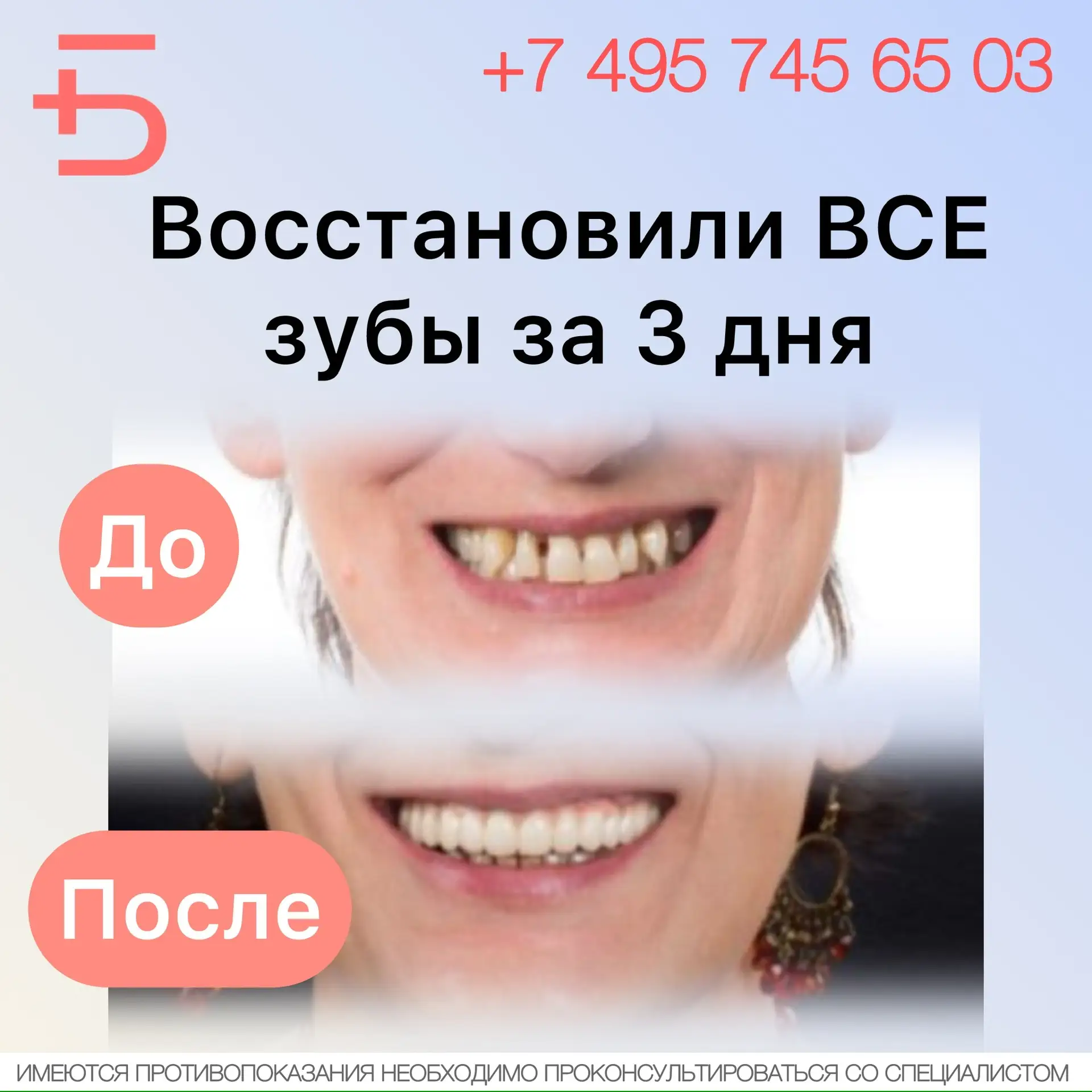🦷 ДО/ПОСЛЕ. Восстановили ВСЕ зубы за 3 дня.   👩🏼‍🦱 Анна Сергеевна обратилась в клинику с проблемами,