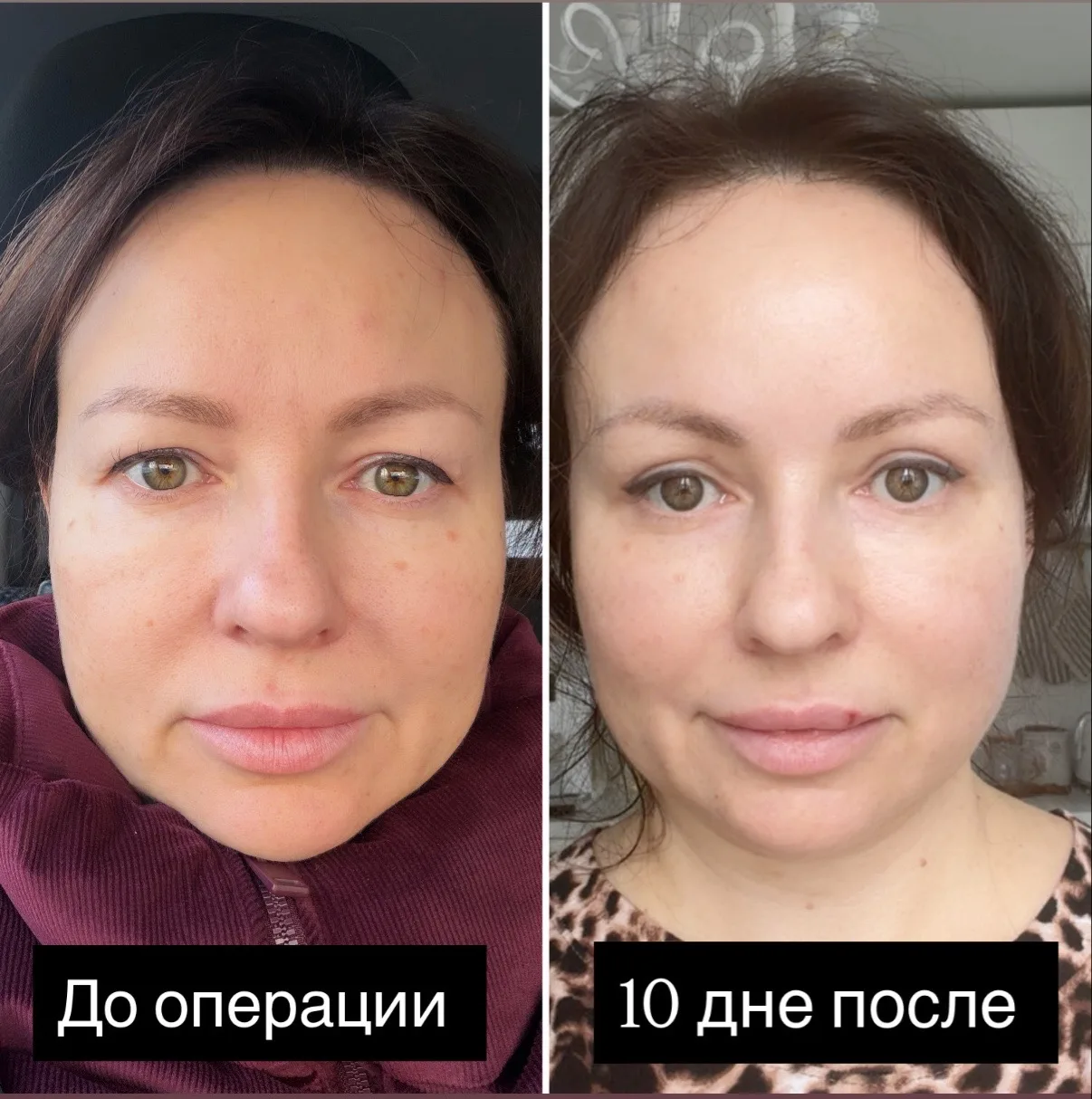 Девчата привет! Решила написать серию постов про операции , которые сделала месяц назад и уже виден 