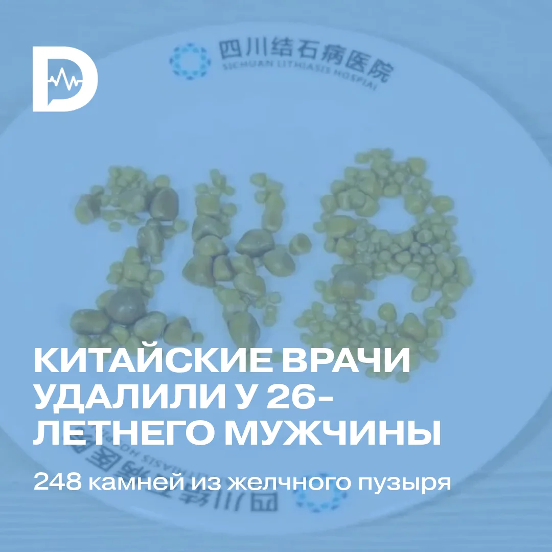 Китайские хирурги удалили у 26-летнего мужчины 248 камней из желчного пузыря. Об этом с...