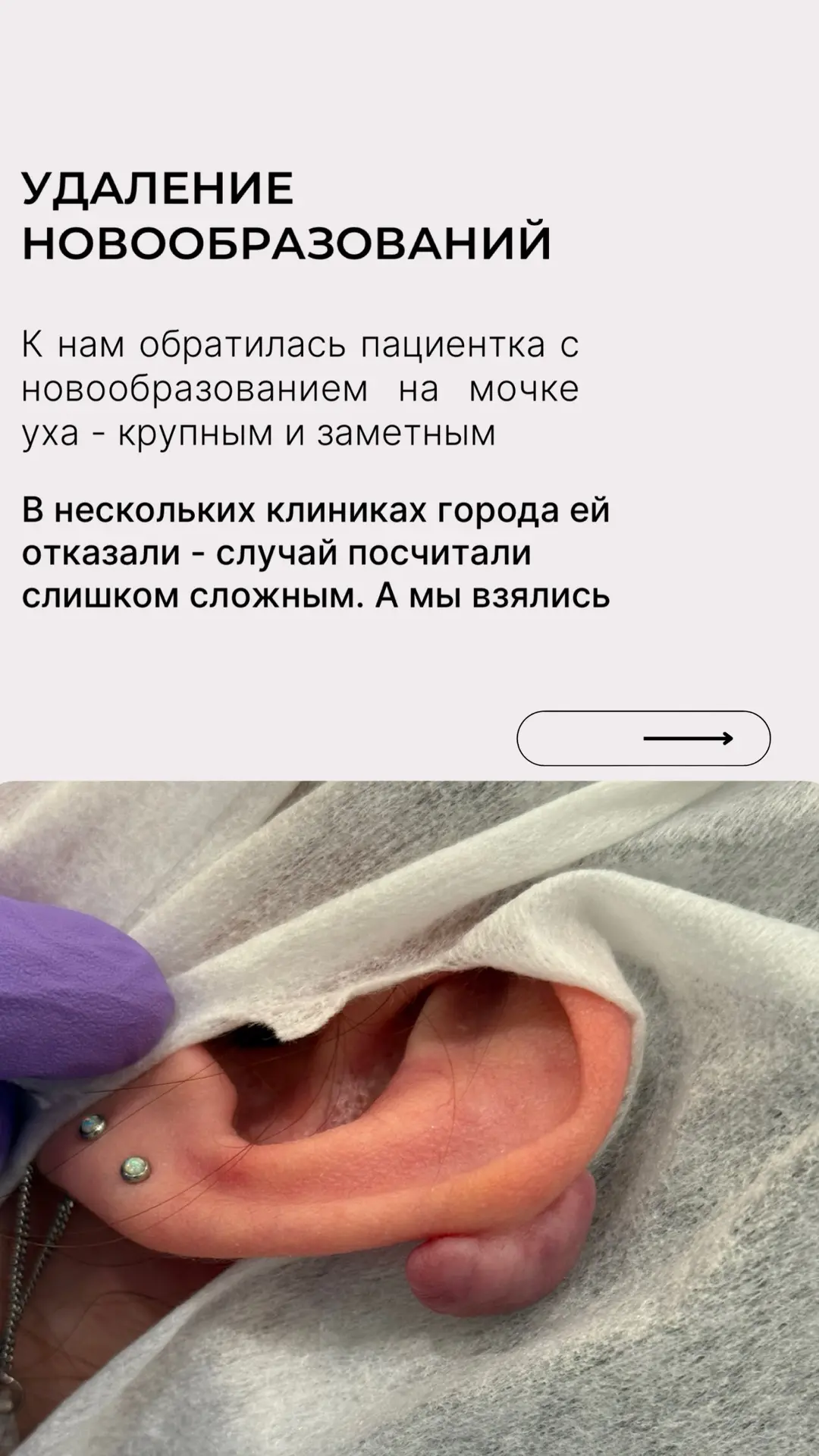 Удаляем новообразования - даже сложные, за которые не берутся другие!⚡️