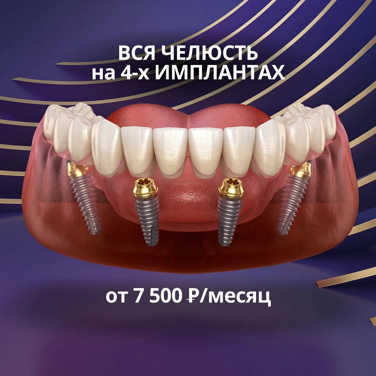 Несъемное протезирование на 4-х имплантах в Тюмени.