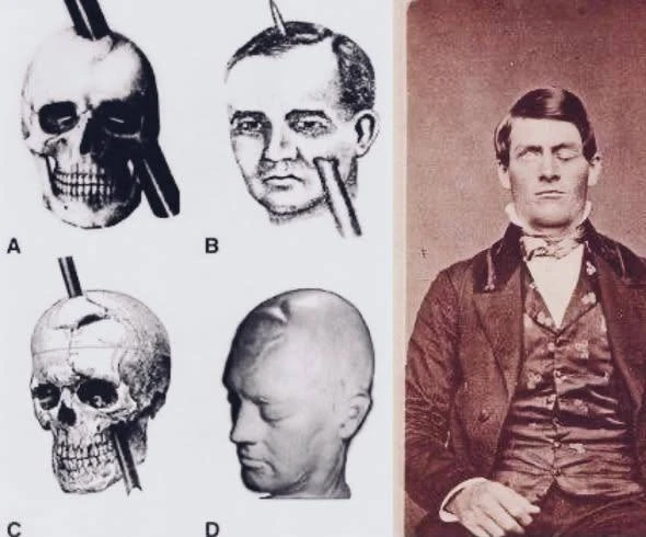 🧠В 1848 году американский рабочий Финеас Гейдж пережил  аварию: во время работ на желе...