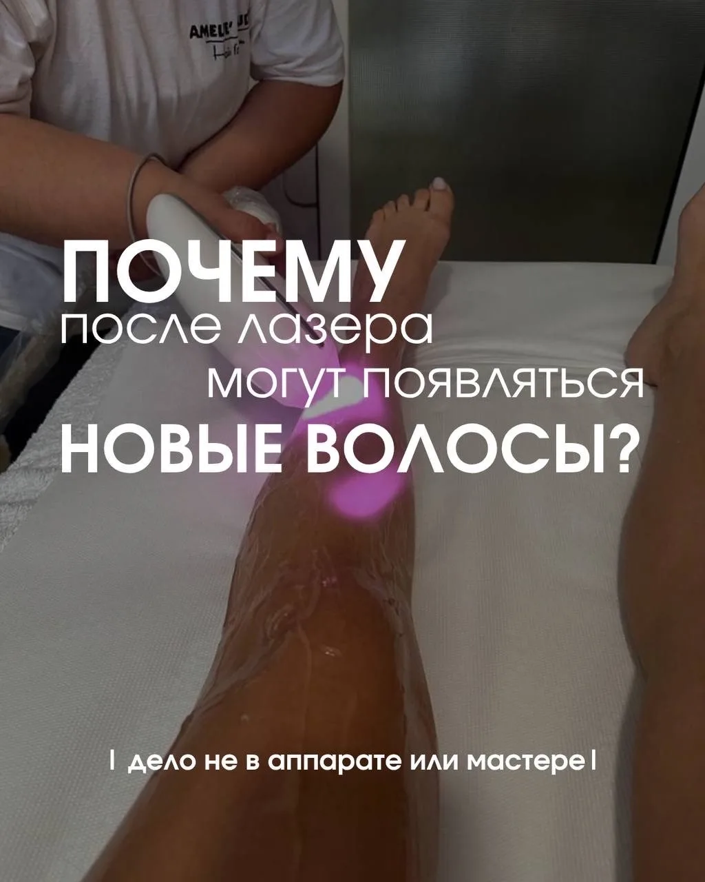 После лазера волосы могут появиться снова — и это нормально!✨