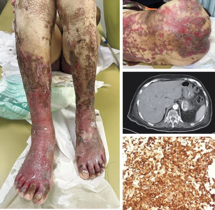 В NEJM (https://www.nejm.org/image-challenge?ci=20260402&startFrom=1&startPage=1) показ...