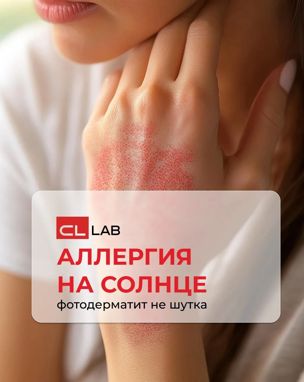 🔬 Аллергия на солнце: шутка или реальность?

Многие удивляются: как может быть аллергия на то, что 