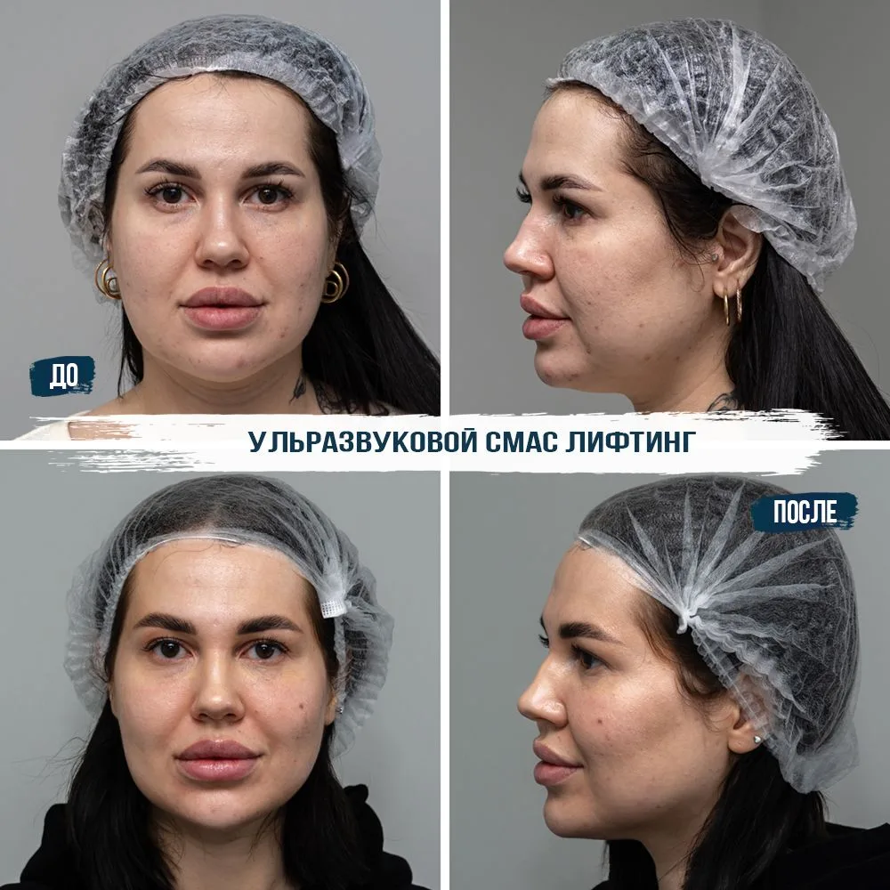 Лифтинг без скальпеля: что остается «за кадром»?