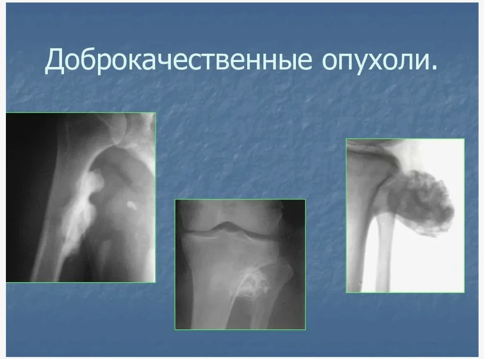 ЗдравКонтроль разьясняет Доброкачественные и злокачественные опухоли — в чем разница? Когда пациент 