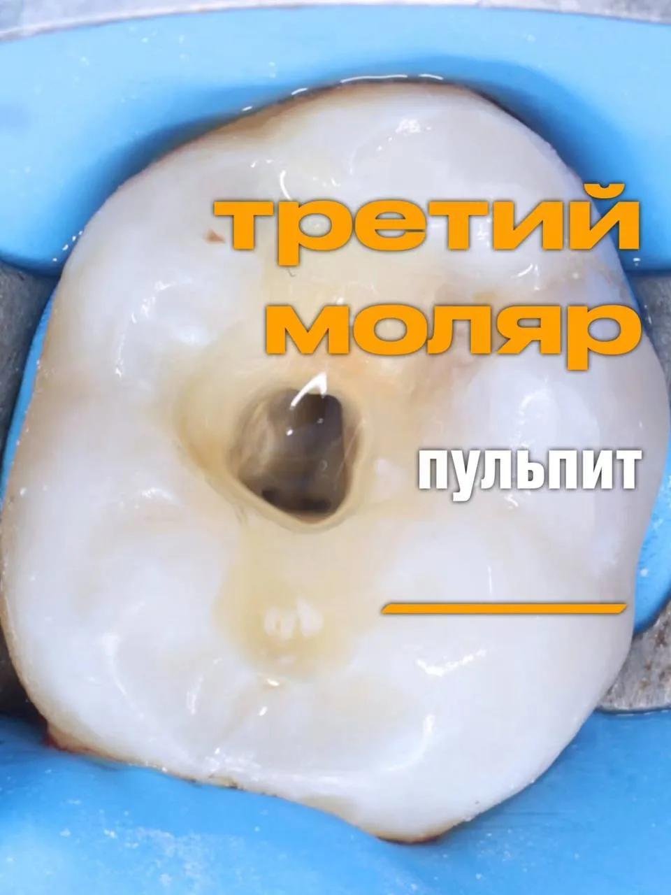 ✨Редкий случай пульпита третьего моляра нижней челюсти, когда зуб в дуге и не является ...