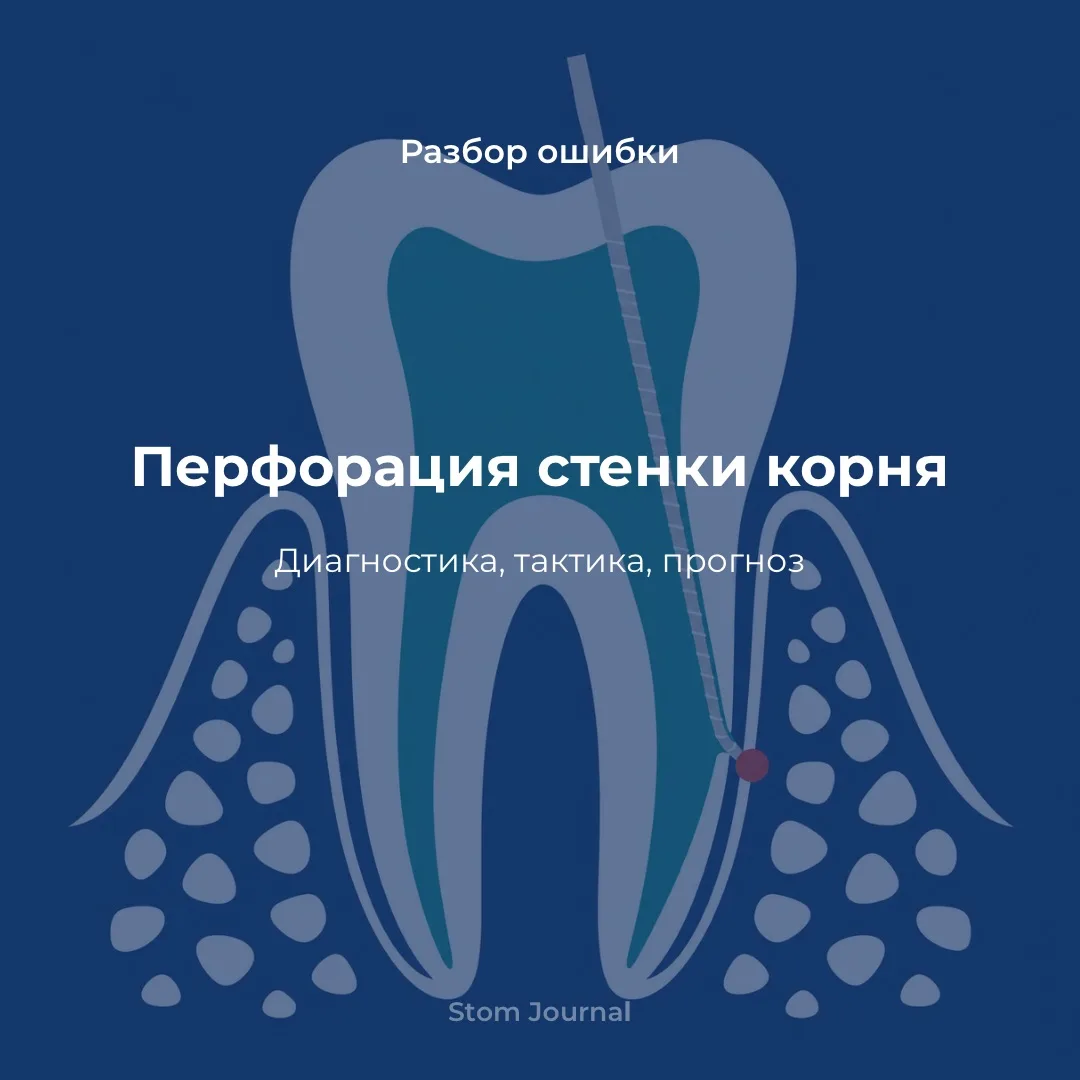 ⚠️ Перфорация стенки корня: диагностика, тактика, прогноз