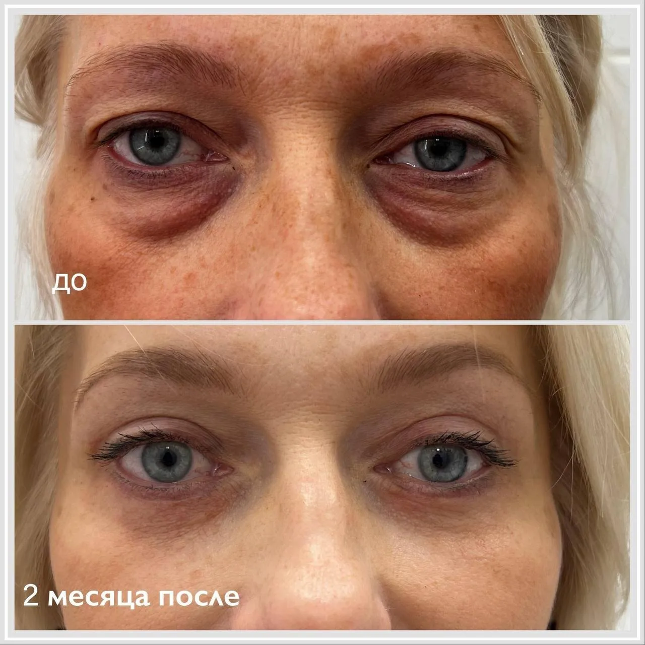 БЛЕФАРОПЛАСТИКА В СЕРГИЕВОМ ПОСАДЕ 👩‍🦳