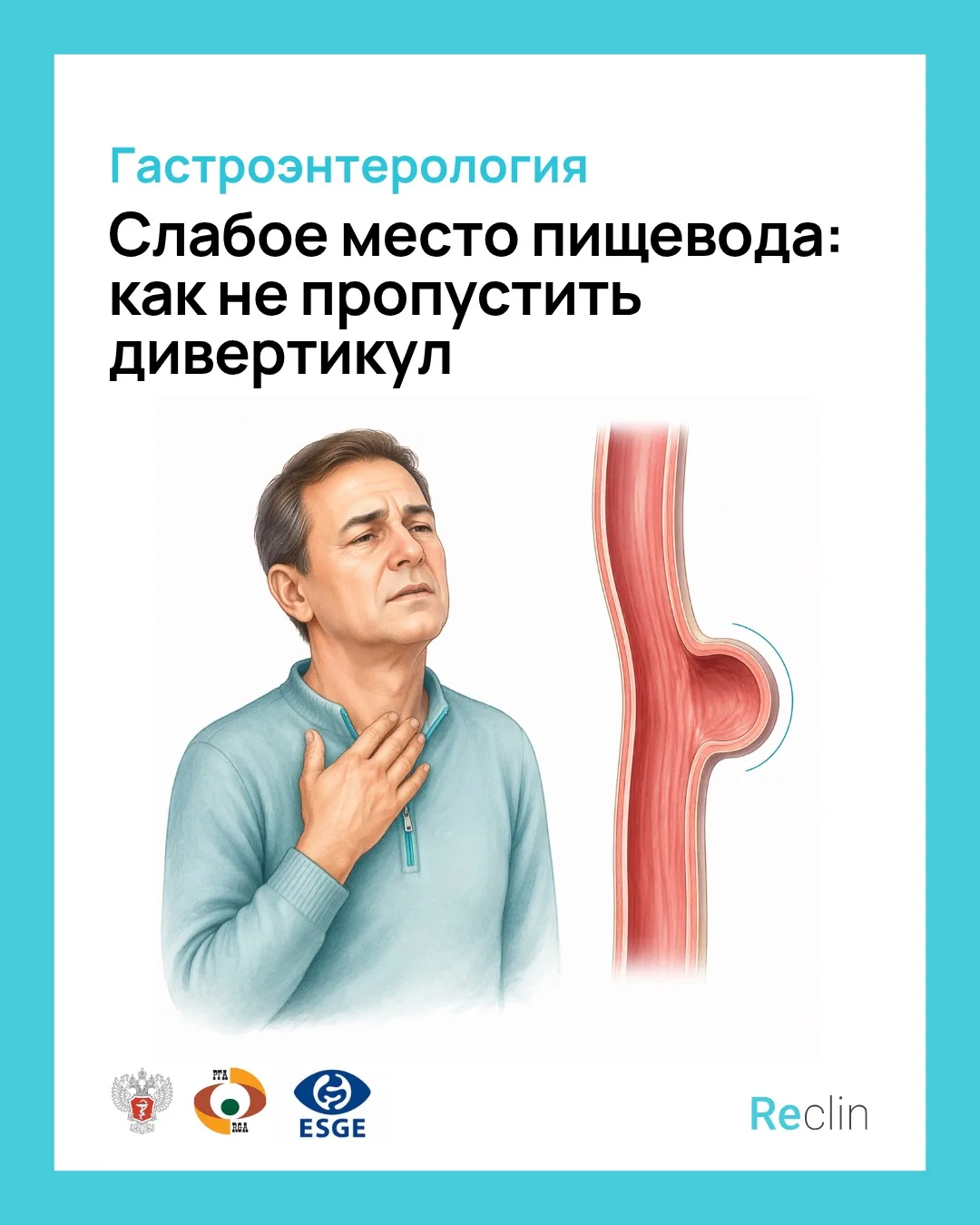 💥 СЛАБОЕ МЕСТО ПИЩЕВОДА: как не пропустить дивертикул 💥