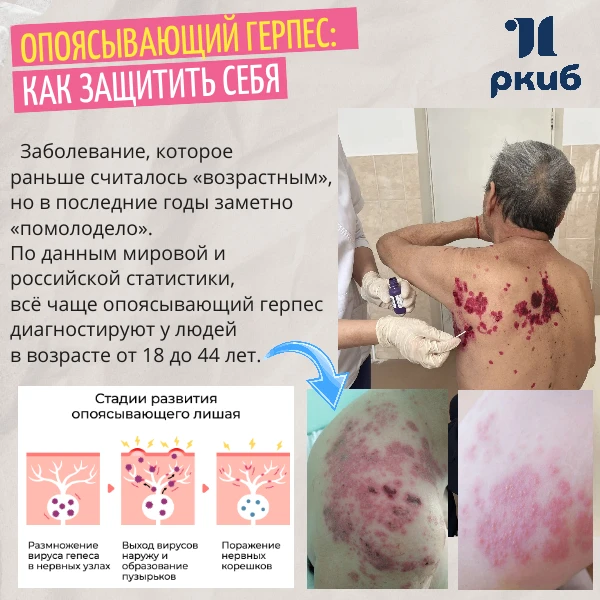 🦠 Опоясывающий герпес: почему он стал чаще встречаться у молодых и как защитить себя