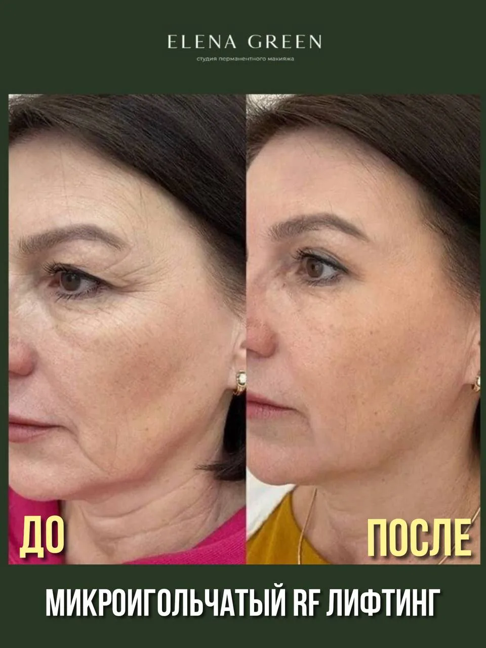 ✨ МИКРОИГОЛЬЧАТЫЙ RF-ЛИФТИНГ В СТУДИИ ELENA GREEN