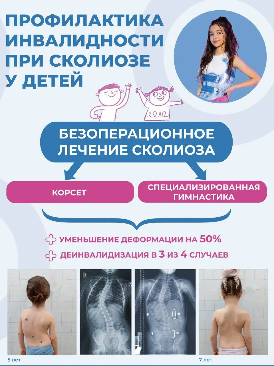 Сколиоз у детей — тихая угроза, которая не проходит сама!