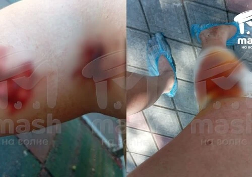 Абсцесс и воспаление вен начались у пациентки гурзуфских врачей после серии перевязок.