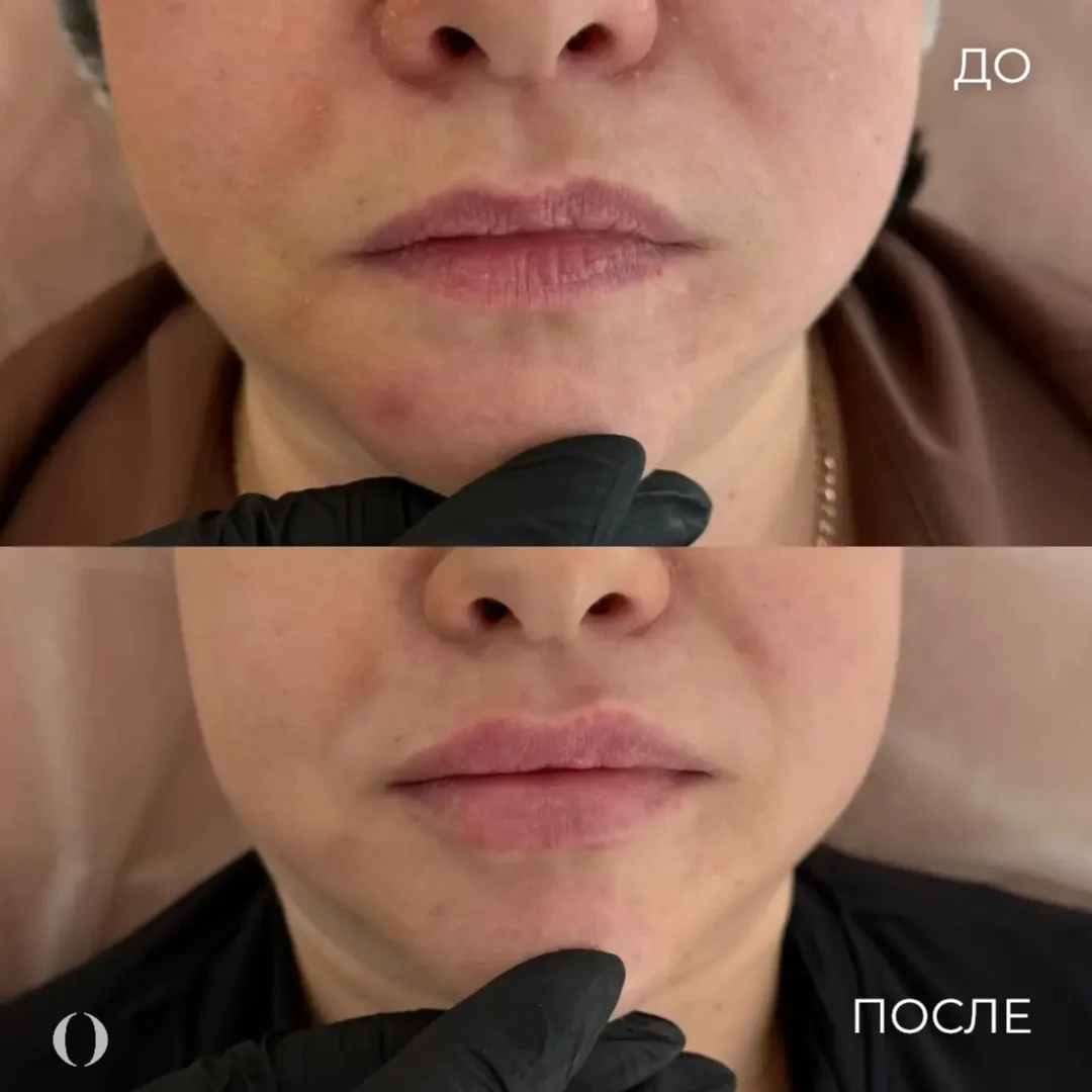 Максимально естественное омоложение губ при помощи филлера e.p.t.q. 💫