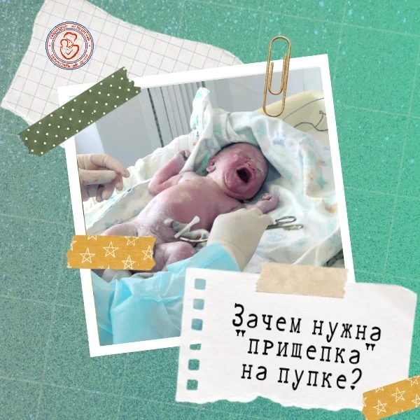 ❓ Зачем нужна «прищепка» на пупке? 

Специальная пластиковая «прищепка», которая накладывается на ос